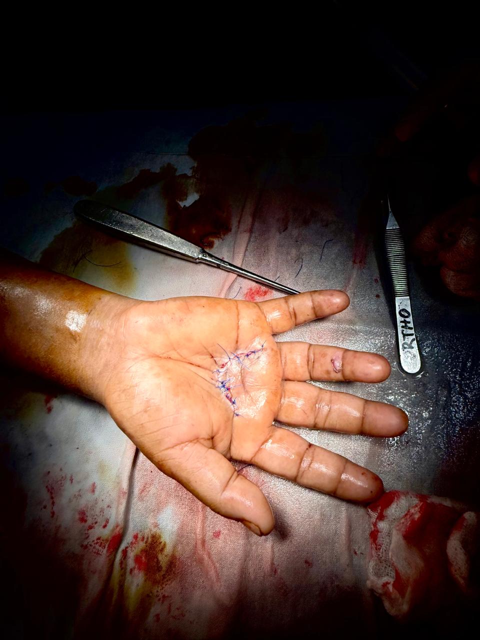 Precision Soft-Tissue Closure